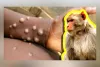 दिल्ली में मंकीपॉक्स का दूसरा मामला