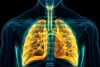 विश्व फेफड़ा कैंसर डे : हर साल फेफड़ों के कैंसर से 75 हजार मौतें, इम्यूनोथैरेपी बनी नई उम्मीद