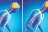 पार्किंसन डे आज : पार्किंसन एक गंभीर न्यूरोलॉजिकल बीमारी एआई से इलाज में आई क्रांति, दवाओं से काफी हद तक नियंत्रण संभव