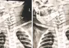 हलक में अटकी क्लिप : एक साल के मासूम की सांसें अटकी, डॉक्टर ने तीसरे प्रयास में पेपर बाइंडिंग क्लिप निकाल बचाई जान