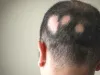 तेजी से बाल झड़ने की गंभीर बीमारी है एलोपीसिया एरेटा