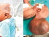 एसएमएस अस्पताल: पांच महीने की मासूम बच्ची के सिर से निकाली दो किलो की गांठ