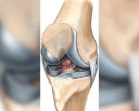 घुटने की सबसे सामान्य चोटों में से एक है एसीएल लिगामेंट इंजरी