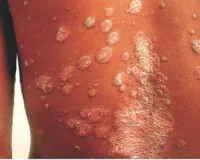 World Psoriasis Day: त्वचा से जुड़ी गैर संक्रामक बीमारी है सोरायसिस  देश में 3 करोड़ से ज्यादा लोग पीड़ित