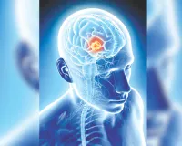 World Brain Stroke Day: स्क्रीनिंग का दायरा बढ़ा, फिर भी गोल्डन ऑवर खत्म होने के बाद अस्पताल पहुंच पा रहे ब्रेन स्ट्रोक के मरीज