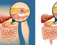 पैंक्रियाटिक कैंसर को लेकर वैज्ञानिकों का दावा : कम साइड इफेक्ट के साथ विकसित की थेरेपी, चूहों पर किए परीक्षण में पूरी तरह खत्म
