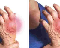 युवाओं में भी बढ़ रही गठिया की बीमारी : जागरूकता के लिए अल्बर्ट हॉल पर होगी वॉकथॉन, मरीजों के साथ आम लोग भी ले सकेंगे भाग