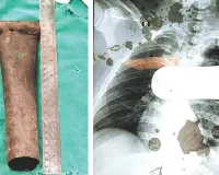 सुपर स्पेशियलिटी हॉस्पिटल की कार्डियोथोरेसिक टीम का कमाल, सीने में धंसा 9 इंच का पाइप निकाल युवक की बचाई जान