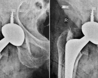 3डी प्रिंटिंग तकनीक से जटिल हिप रिप्लेसमेंट सर्जरी : सामान्य सर्जरी से कहीं अधिक चुनौतीपूर्ण था केस, अपनी जगह से खिसक गया था कृत्रिम कप 