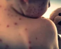 बांग्लादेश में ख़सरे का प्रकोप: लगातार बढ़ रहे बच्चों की मौत के मामले, 24 घंटों में संक्रमण के 685 नए मामले सामने आए 