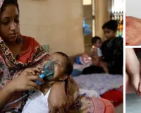 बांग्लादेश में खसरे से हाहाकार : एक दिन में 17 लोगों की मौत; तेजी से बढ़ रहे केस, सरकार ने जारी किया अलर्ट
