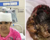 जटिल एवं विशाल सिर के ट्यूमर का सफल ऑपरेशन, एसएमएस मेडिकल कॉलेज की टीम ने रचा नया इतिहास 