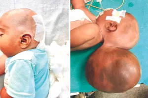 एसएमएस अस्पताल: पांच महीने की मासूम बच्ची के सिर से निकाली दो किलो की गांठ