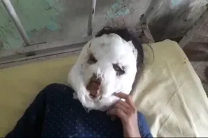 कुकर से चेहरे पर गिरा गर्म पानी, बारह साल की बच्ची का चेहरा झुलसा, इलाज जारी
