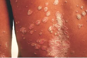 World Psoriasis Day: त्वचा से जुड़ी गैर संक्रामक बीमारी है सोरायसिस  देश में 3 करोड़ से ज्यादा लोग पीड़ित