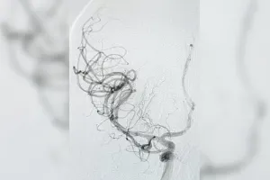 मैकेनिकल थ्रोम्बेक्टोमी तकनीक से बचाई विदेशी पर्यटक की जान