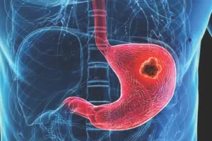 एब्डॉमिनल कैंसर डे आज : राजस्थान में भी एब्डॉमिनल कैंसर के मामलों में 25 फीसदी तक हुई बढ़ोतरी