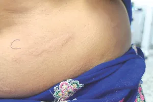 शरीर पर पानी गिरते ही हो जाते हैं खुजली और लाल धब्बे : 45 वर्षीय महिला को पानी से एलर्जी, दुर्लभ एक्वाजेनिक अर्टिकारिया का मामला सामने आया