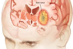 वर्ल्ड ब्रेन ट्यूमर डे : एक लाख लोगों में 5 से 10 को ब्रेन ट्यूमर, बच्चों में होने वाले कैंसर में 12 प्रतिशत मामले इसी तरह के