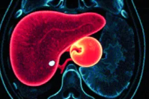 गर्भाशय की जगह लिवर में हो गया गर्भधारण : एमआरआई में आया सामने, भ्रूण में चल रही धड़कन