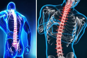 रीढ़ की हड्डी का एक ओर मुड़ना स्कोलियोसिस के लक्षण, न्यूरो और ऑर्थोपैडिक सर्जन्स की सलाह : स्कोलियोसिस के बारे में जागरूकता जरूरी