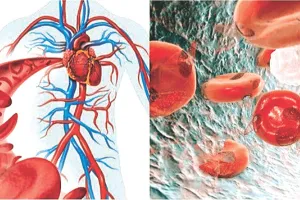 इस आनुवंशिक बीमारी का स्टेम सेल थैरेपी से इलाज संभव : राजस्थान में बढ़ रहे सिकल सेल के रोगी आदिवासी जिलों में प्रभाव ज्यादा 