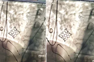 एसएमएस अस्पताल : हार्ट में पहले लगे सर्जिकल वॉल्व में बिना ऑपरेशन किए दोबारा कृत्रिम वॉल्व लगाया 