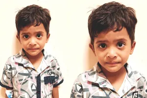 आरयूएचएस अस्पताल : सर्जरी कर बचाई 5 वर्ष के बच्चे की जान, खाने की नली से सिक्का निकाला