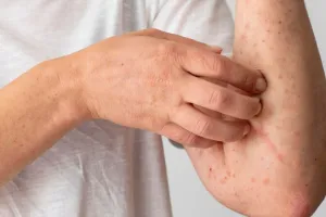 कमजोर प्रतिरोधक क्षमता पर फंगस का वार