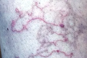 कुटेनीयस लार्वा माइग्रेंस : नंगे पांव चलने से फैली बीमारी, तीन माह तक पीड़ित रही झुंझुनूं की महिला