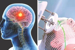 ब्रेन ट्यूमर के तेजी से बढ़ रहे मामले, हर एक लाख लोगों में से 10 लोग ब्रेन या सीएनएस ट्यूमर से पीड़ित