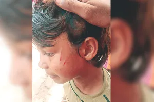 बेरहम शिक्षक : चौथी कक्षा की छात्रा के चेहरे और पीठ पर छड़ी की मार, राजकीय प्राथमिक स्कूल जेवर का मामला