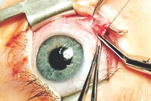  आंखों में ही उग आया दांत : मरीज को रहने लगा सिर में दर्द, दिखना भी कम हुआ; डॉक्टरों ने सर्जरी कर निकाला