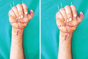 एम्स जोधपुर का कमाल : युवक के दोनों कटे हाथों को ऑपरेशन कर जोड़ा, 12 घण्टे की मशक्कत के बाद मिली सफलता