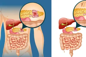 पैंक्रियाटिक कैंसर को लेकर वैज्ञानिकों का दावा : कम साइड इफेक्ट के साथ विकसित की थेरेपी, चूहों पर किए परीक्षण में पूरी तरह खत्म