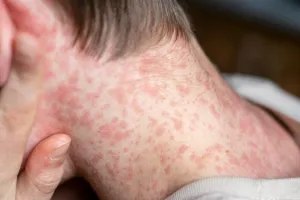 अमेरिका में 33 वर्षों का रिकॉर्ड टूटा,  साल 1992 के बाद 2025 में खसरे के 2,000 से अधिक मामले दर्ज