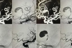 एंडोवस्कुलर सिंपल कॉइलिंग तकनीक से जटिल उपचार किया : बिना ओपन सर्जरी विशाल ब्रेन एन्यूरिज्म का सफल इलाज, युवा मरीज दूसरे दिन डिस्चार्ज
