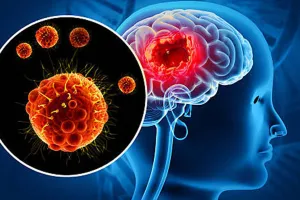 ब्रिटेन में दिमागी बुखार का प्रकोप: मेनिंजाइटिस बी और डब्ल्यू स्ट्रेन के मामले सर्वाधिक, स्वास्थ्य विभाग ने जारी किया ‘हाई अलर्ट’