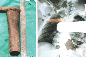 सुपर स्पेशियलिटी हॉस्पिटल की कार्डियोथोरेसिक टीम का कमाल, सीने में धंसा 9 इंच का पाइप निकाल युवक की बचाई जान