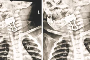 हलक में अटकी क्लिप : एक साल के मासूम की सांसें अटकी, डॉक्टर ने तीसरे प्रयास में पेपर बाइंडिंग क्लिप निकाल बचाई जान