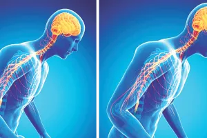 पार्किंसन डे आज : पार्किंसन एक गंभीर न्यूरोलॉजिकल बीमारी एआई से इलाज में आई क्रांति, दवाओं से काफी हद तक नियंत्रण संभव