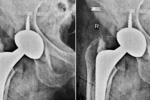 3डी प्रिंटिंग तकनीक से जटिल हिप रिप्लेसमेंट सर्जरी : सामान्य सर्जरी से कहीं अधिक चुनौतीपूर्ण था केस, अपनी जगह से खिसक गया था कृत्रिम कप 