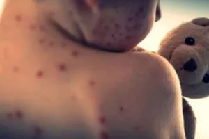 बांग्लादेश में ख़सरे का प्रकोप: लगातार बढ़ रहे बच्चों की मौत के मामले, 24 घंटों में संक्रमण के 685 नए मामले सामने आए 