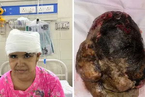 जटिल एवं विशाल सिर के ट्यूमर का सफल ऑपरेशन, एसएमएस मेडिकल कॉलेज की टीम ने रचा नया इतिहास 