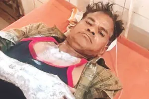 कचौड़ी के पैसे मांगना पड़ा भारी, दुकानदार पर खौलता तेल उड़ेलकर आरोपी फरार